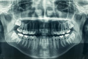 panoramic dental xray
