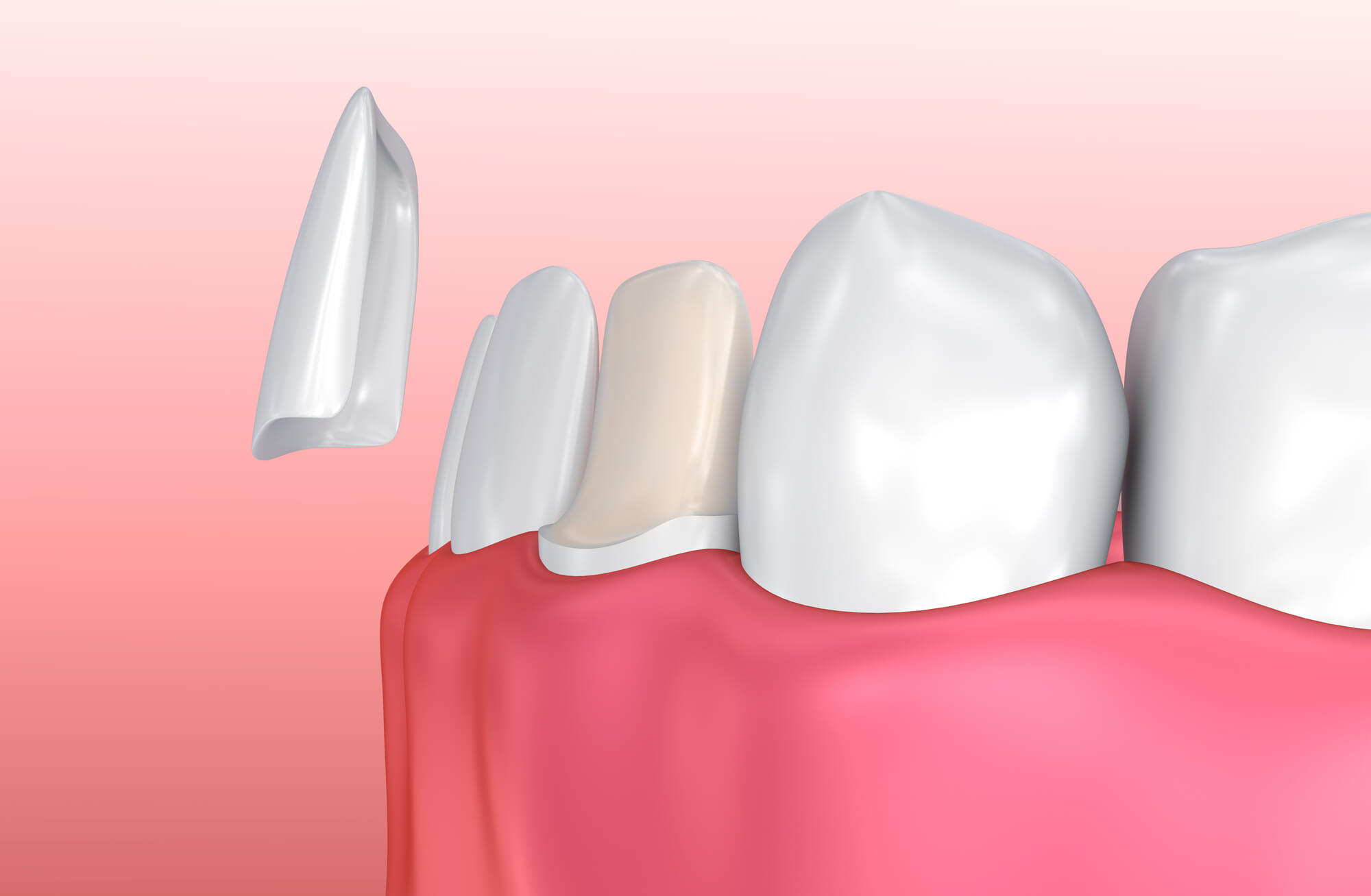 Where can I get Veneers Oak Park?