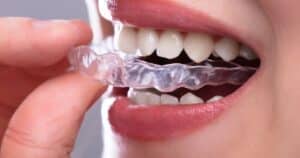 Invisalign in Oak Park - correcting overbites