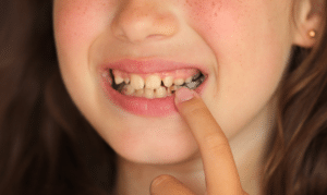 Cracking the Code of Tooth Decay- Prevention and Treatment Strategies