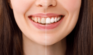 From Coffee Stains to Crystal Clear- How Teeth Whitening Can Reverse Discoloration