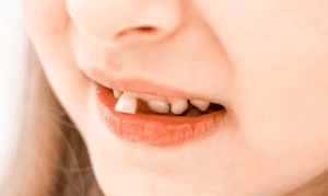 Lost Baby Tooth? A Guide to Saving and Reimplanting Knocked-Out Teeth