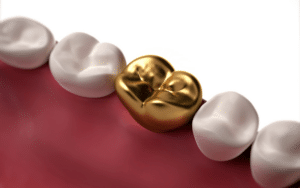 Best Dental Filling For Cavity