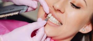 porcelain veneers for valentine's day