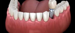 How to Care for Your Dental Implants Tips for Long-Lasting Results